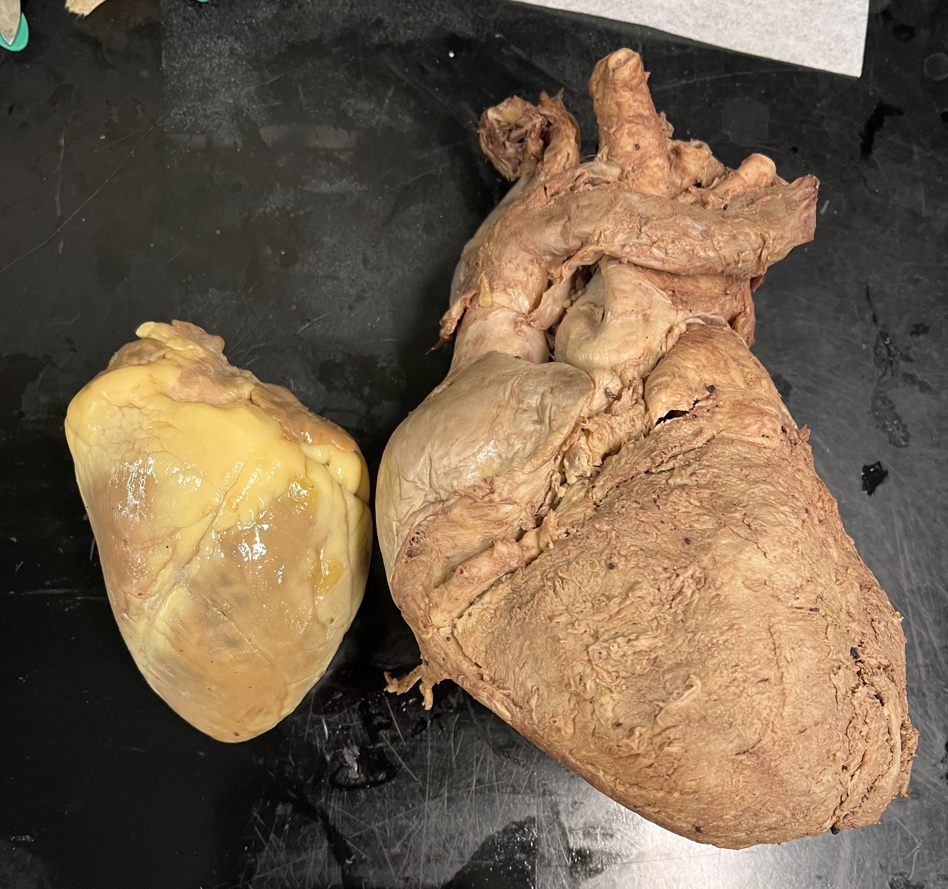 Enlarged Heart image